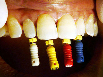 Root Canal Treatment (RCT) 