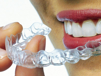 Invisible Braces & Dental Implants 