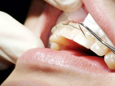 Orthodontic Treatment 