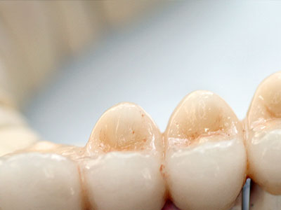 Porcelain/ Ceramic Inlays 