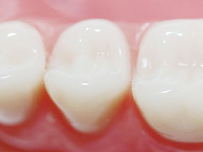  Composite Resin Fillings