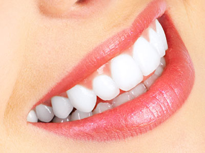 1 Hour Teeth Whitening 