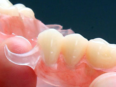 Partial Dentures