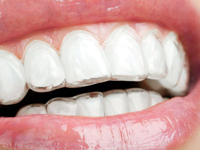 Night Guard For Bruxisim 